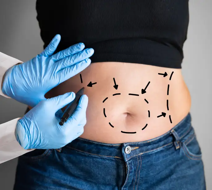 Benefits of the Smart Lipo Procedure