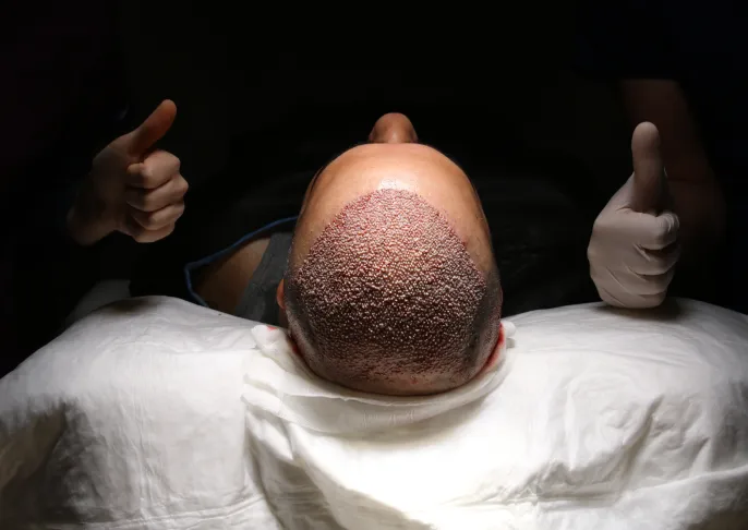 How Does Hair Transplantation Work