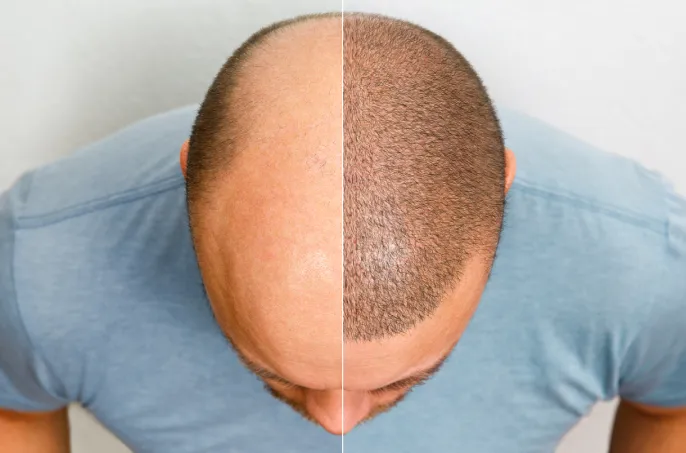 What is Hair Transplantation