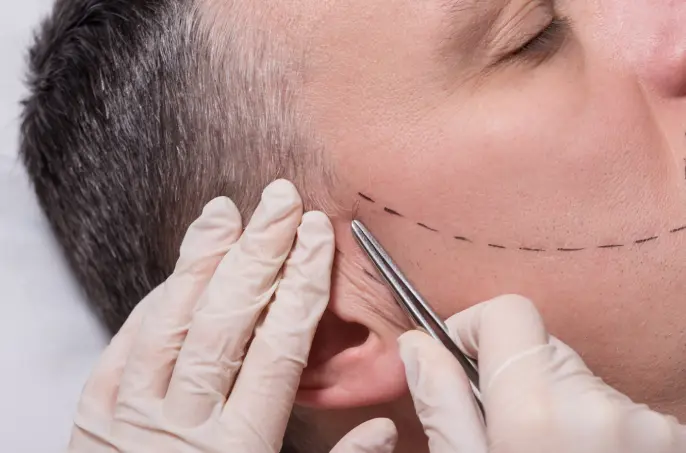 When Should You Go for an Eyebrow or Beard Transplant